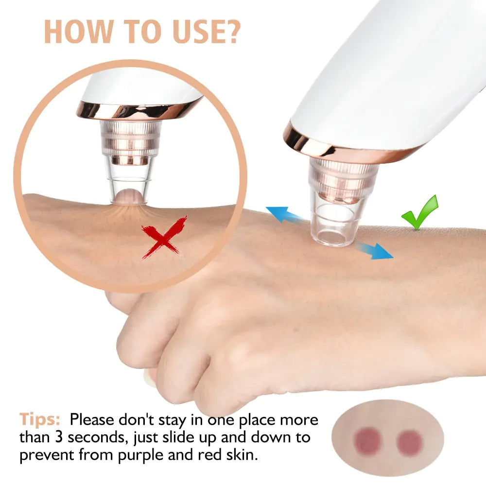 Electric Blackhead Remover Bloom Aura™