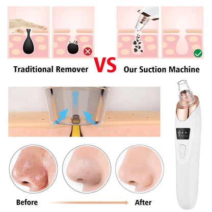 Electric Blackhead Remover Bloom Aura™